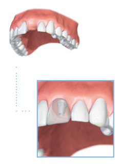 Single Tooth Implant